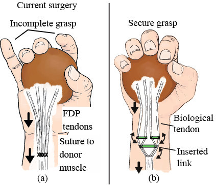 Implantable adaptive grasping mechanism