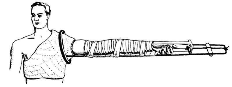 Ancient versions of twisted string actuators